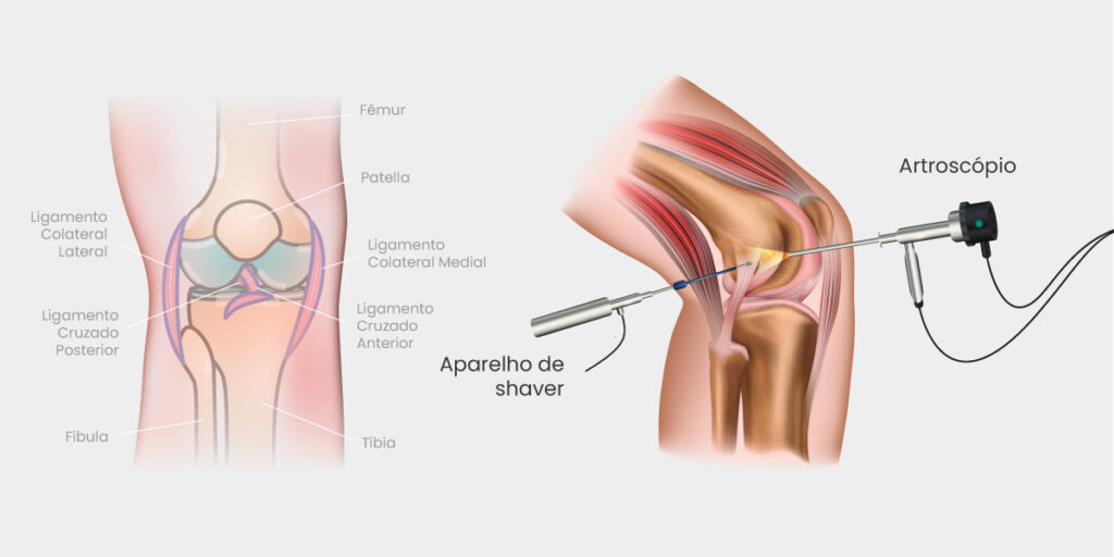 Artroscopia do Joelho