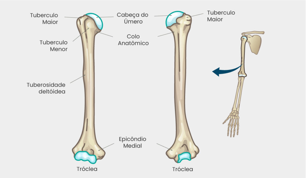 Tratamento para Fratura do Úmero