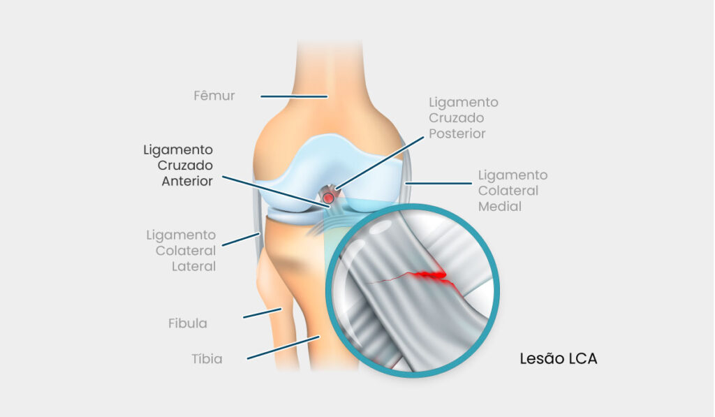 Lesão do Ligamento Cruzado Anterior - LCA