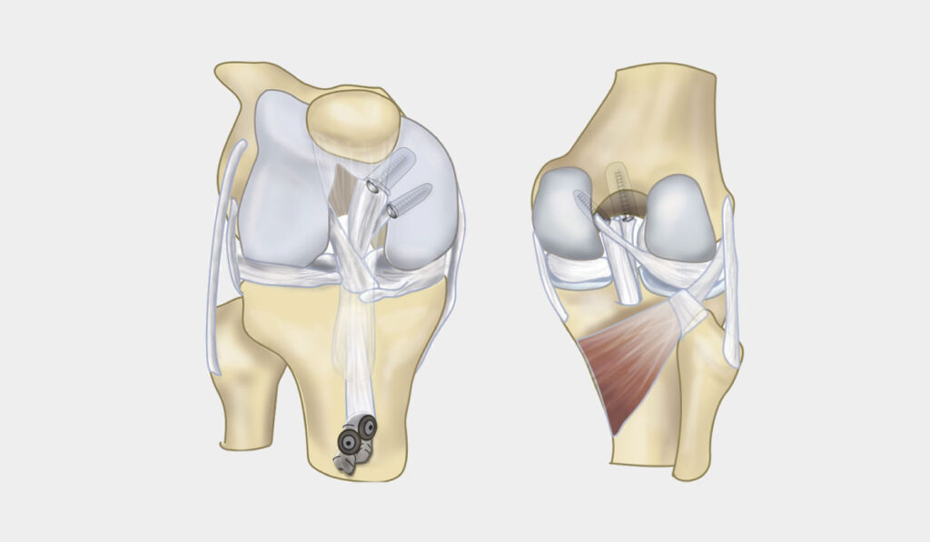 Cirurgia Ligamento Cruzado Posterior