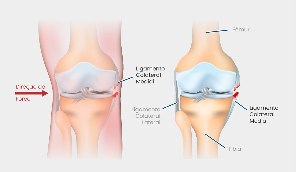 ligamento colateral lateral