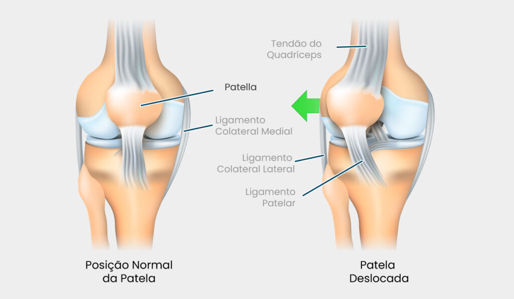 Luxação Patela Anatomia