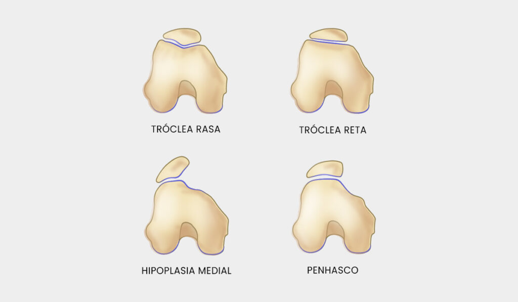 Formato do Femur