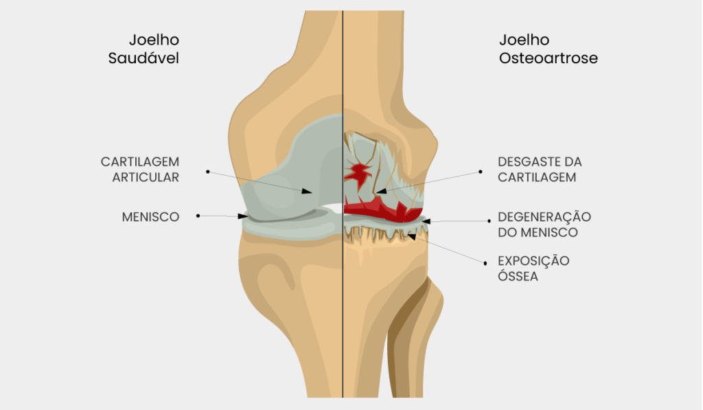 Quanto custa uma prótese de joelho?